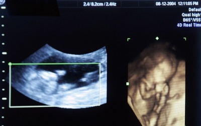 Phẫu thuật tim cho thai nhi nằm trong bụng mẹ